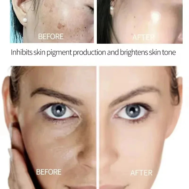 Niacinamide Dark Spot Remove Serum Face Freckle Melanin Correcting Moisturizing Brightening Anti Pigmentation Repair Skin Care