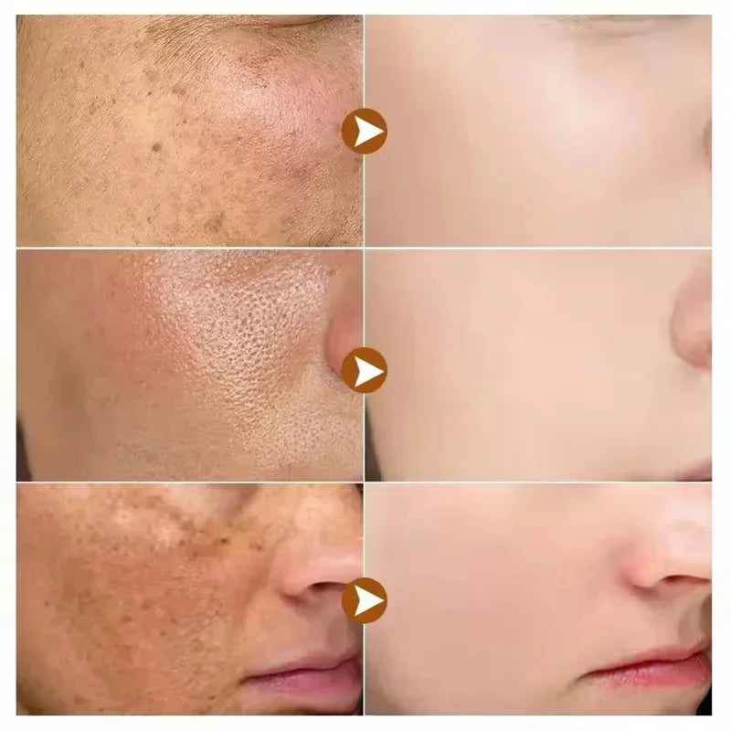 Niacinamide Dark Spot Remove Serum Face Freckle Melanin Correcting Moisturizing Brightening Anti Pigmentation Repair Skin Care