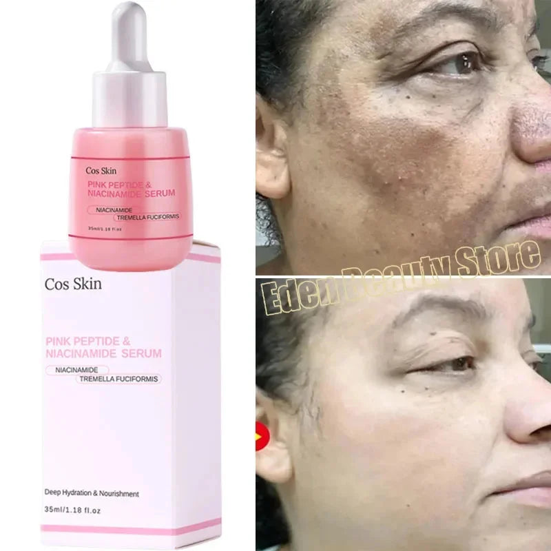 Niacinamide Dark Spot Remove Serum Face Freckle Melanin Correcting Moisturizing Brightening Anti Pigmentation Repair Skin Care